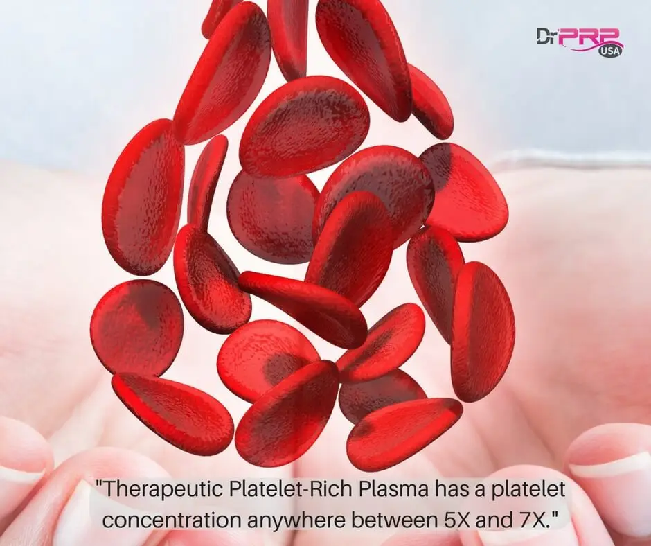 Therapeutic PRP has platelet concentration between 5X and 7X