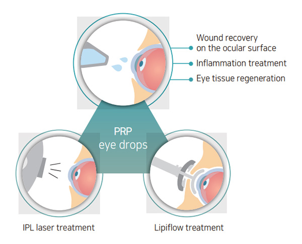 Treatment with PRP eye drops